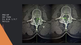 PRE OP
DH -7MM
FA –R 44 L 51.7
NO LLS
 