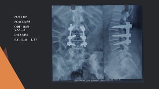 POST OP
POWER 5/5
ODI - 16/50
VAS – 3
DH-8 MM
FA – R 40 L 37
 