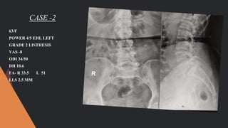 CASE -2
63/F
POWER 4/5 EHL LEFT
GRADE 2 LISTHESIS
VAS -8
ODI 34/50
DH 10.6
FA- R 33.5 L 51
LLS 2.5 MM
 