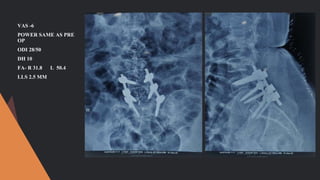 VAS -6
POWER SAME AS PRE
OP
ODI 28/50
DH 10
FA- R 31.8 L 50.4
LLS 2.5 MM
 