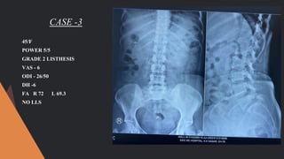 CASE -3
45/F
POWER 5/5
GRADE 2 LISTHESIS
VAS - 6
ODI - 26/50
DH -6
FA R 72 L 69.3
NO LLS
 