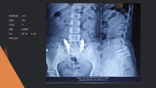 POWER - 5/5
ODI - 24
VAS - 5
DH - 6MM
FA - R 76 L 66
NO LLS
 