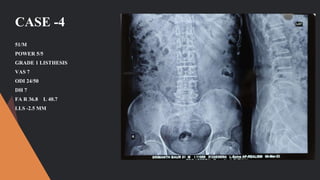 CASE -4
51/M
POWER 5/5
GRADE 1 LISTHESIS
VAS 7
ODI 24/50
DH 7
FA R 36.8 L 40.7
LLS -2.5 MM
 