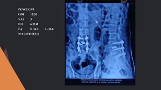 POWER 5/5
ODI 12/50
VAS 3
DH 6 MM
FA R 34.2 L-38.6
NO LISTHESIS
 