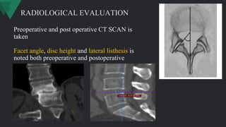Preoperative and post operative CT SCAN is
taken
Facet angle, disc height and lateral listhesis is
noted both preoperative and postoperative
RADIOLOGICAL EVALUATION
 