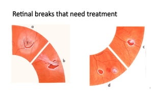 Management of Retinal Detachment (Retina) .pptx