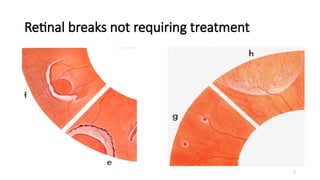 Management of Retinal Detachment (Retina) .pptx