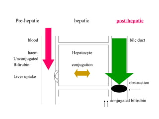 Pre-hepatic  hepatic  post-hepatic blood  bile duct haem  Hepatocyte Unconjugated Bilirubin  conjugation Liver uptake obstruction conjugated bilirubin 