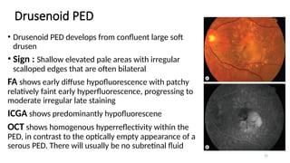 Wet Age Related Macular Degeneration and Choroidal Neovascular Membrane ...