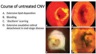 Wet Age Related Macular Degeneration and Choroidal Neovascular Membrane ...