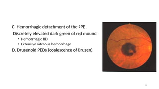 Wet Age Related Macular Degeneration and Choroidal Neovascular Membrane ...