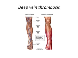 Deep vein thrombosis
 