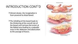 Infloding INTUSSUSCEPTION lecture for medical students.pptx