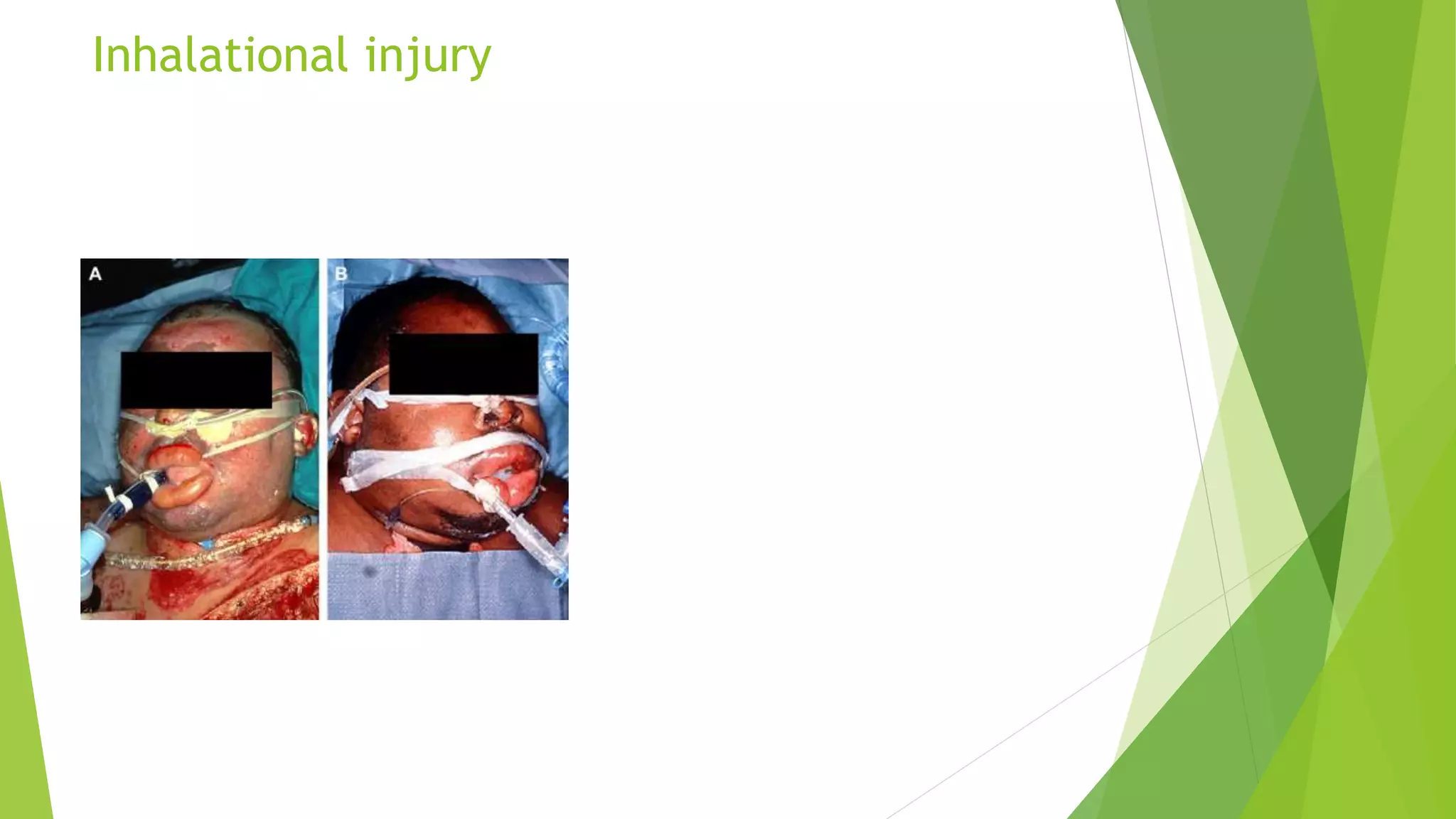 Inhalational injury
 