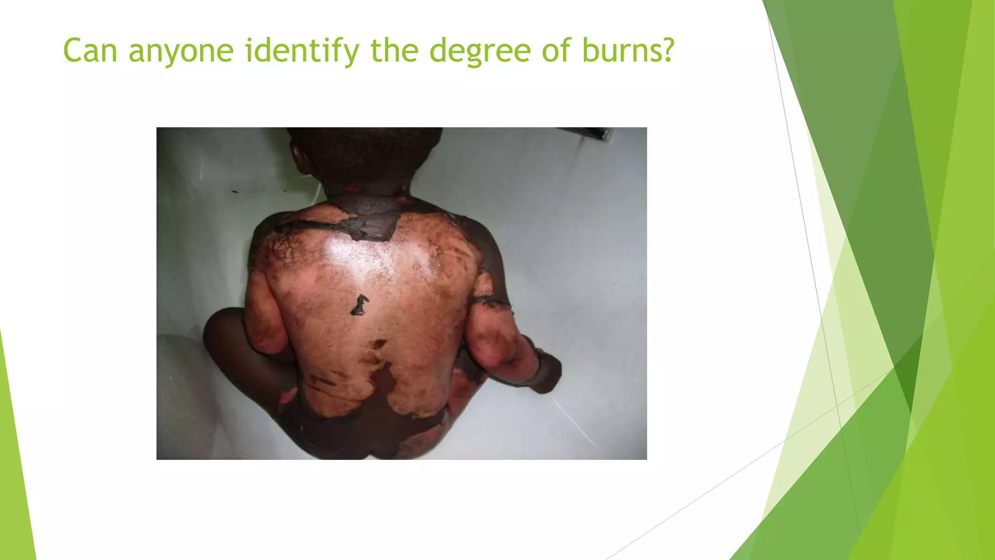 Can anyone identify the degree of burns?
 