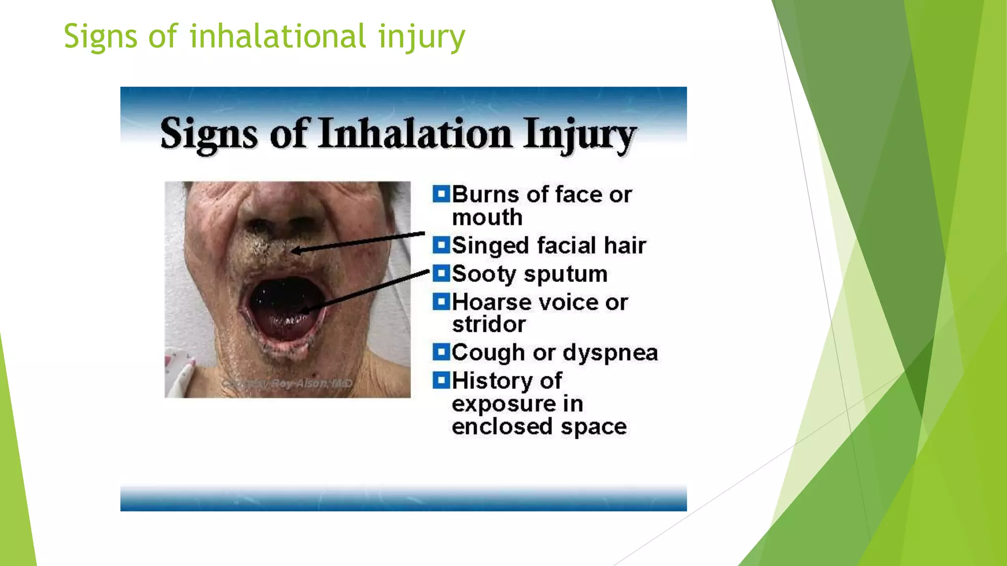 Signs of inhalational injury
 