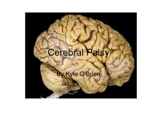Cerebral Palsy
By Kyle O'Brien
 