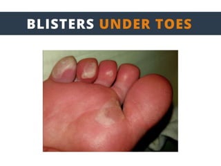 ENGO Blister Patch Placement Masterclass