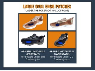 ENGO Blister Patch Placement Masterclass