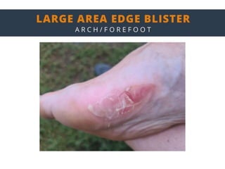 ENGO Blister Patch Placement Masterclass