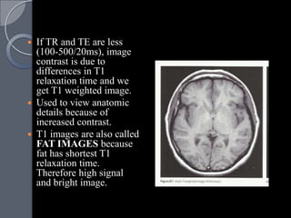  If TR and TE are less
  (100-500/20ms), image
  contrast is due to
  differences in T1
  relaxation time and we
  get T1 weighted image.
 Used to view anatomic
  details because of
  increased contrast.
 T1 images are also called
  FAT IMAGES because
  fat has shortest T1
  relaxation time.
  Therefore high signal
  and bright image.
 