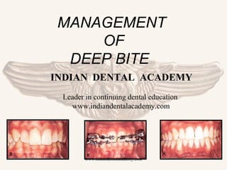MANAGEMENT
OF
DEEP BITE
INDIAN DENTAL ACADEMY
Leader in continuing dental education
www.indiandentalacademy.com

www.indiandentalacademy.com

 