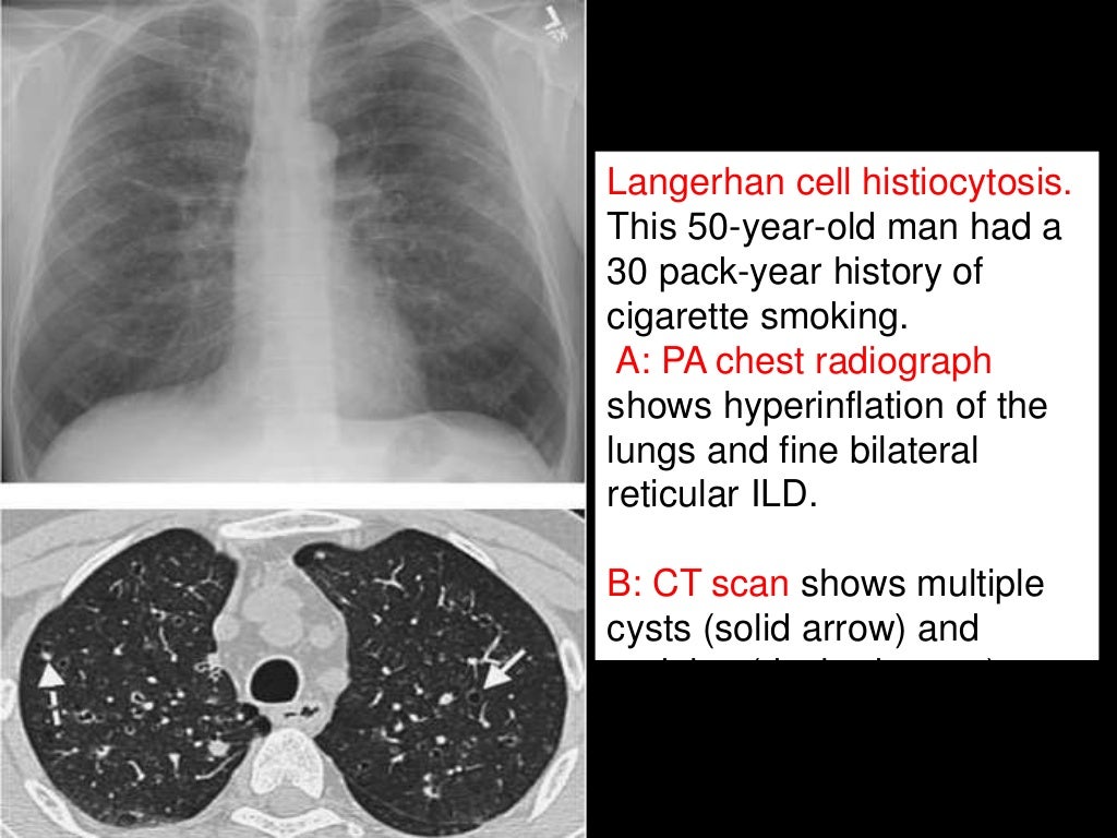 Diffuse Parenchymal Lung Diseases