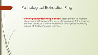 Pathologic Retraction Ring Comprehensive Overview of Abnormal Labor: Induction, Dystocia, and ...