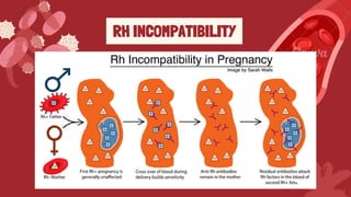 Copy of RH, ABO INCOMPATBILITY AND PHOTOTHERAPY.pdf.pdf