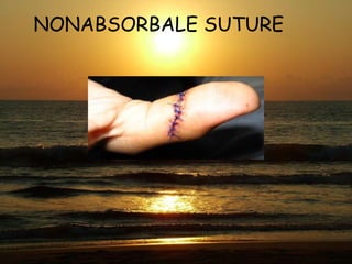 NONABSORBALE SUTURE 