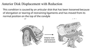Comprehensive Overview of Temporomandibular Joint Disorders: Etiology ...