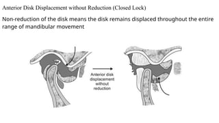 Comprehensive Overview of Temporomandibular Joint Disorders: Etiology ...