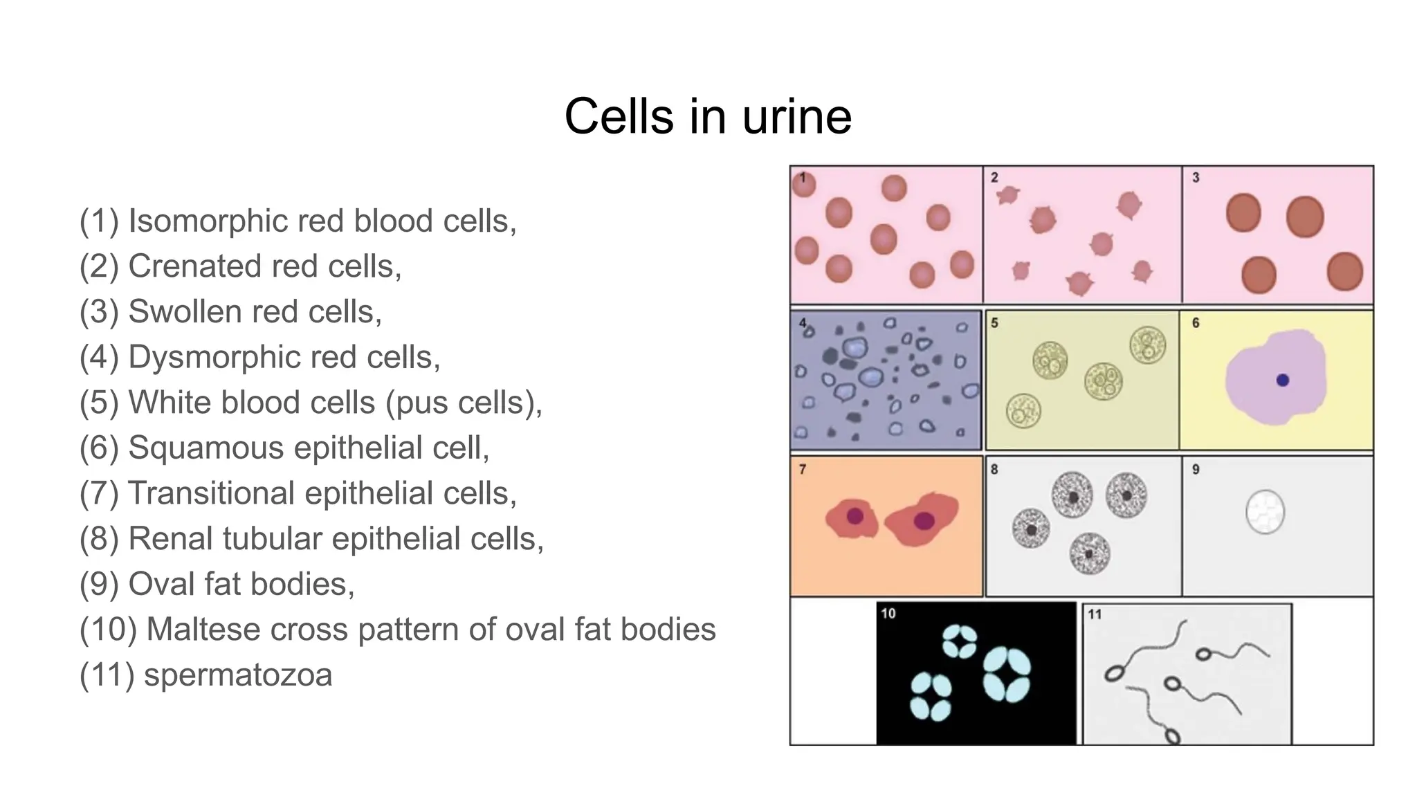 Cells in urine
(1) Isomorphic red blood cells,
(2) Crenated red cells,
(3) Swollen red cells,
(4) Dysmorphic red cells,
(5) White blood cells (pus cells),
(6) Squamous epithelial cell,
(7) Transitional epithelial cells,
(8) Renal tubular epithelial cells,
(9) Oval fat bodies,
(10) Maltese cross pattern of oval fat bodies
(11) spermatozoa
 