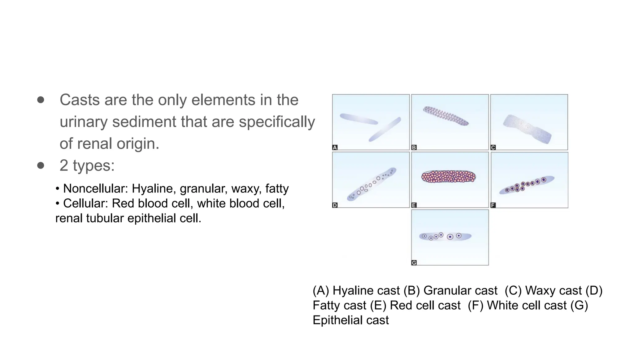● Casts are the only elements in the
urinary sediment that are specifically
of renal origin.
● 2 types:
(A) Hyaline cast (B) Granular cast (C) Waxy cast (D)
Fatty cast (E) Red cell cast (F) White cell cast (G)
Epithelial cast
• Noncellular: Hyaline, granular, waxy, fatty
• Cellular: Red blood cell, white blood cell,
renal tubular epithelial cell.
 