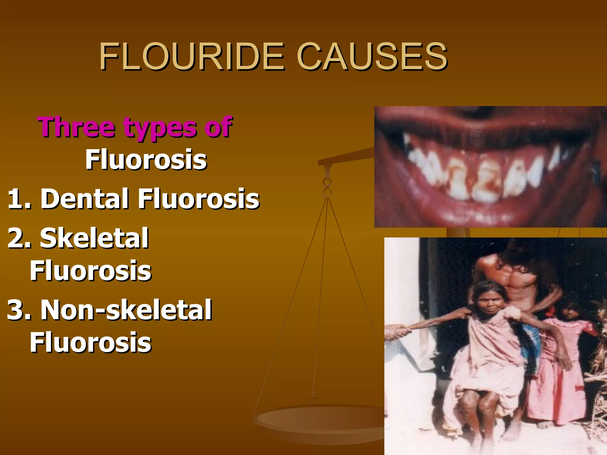FLOURIDE CAUSES Three types of  Fluorosis 1. Dental Fluorosis 2. Skeletal Fluorosis 3. Non-skeletal Fluorosis 