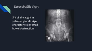 Approach to X ray Abdomen and KUB.pptx
