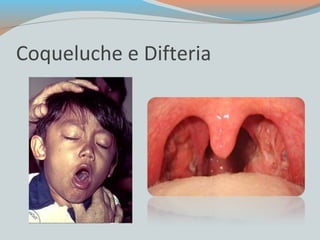 Coqueluche e Difteria 
 