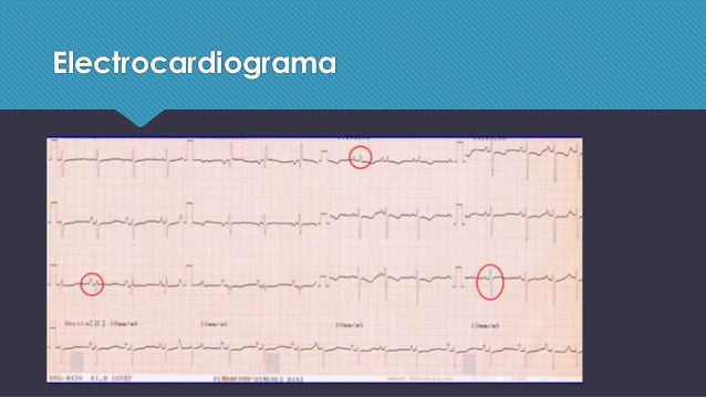 Aprender más sobre hipertensión craneal