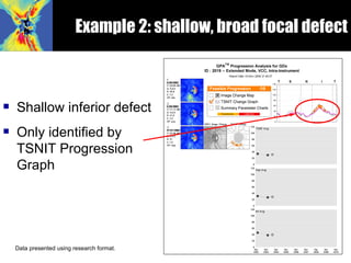 <ul><li>Shallow inferior defect </li></ul><ul><li>Only identified by TSNIT Progression Graph </li></ul>Data presented usin...
