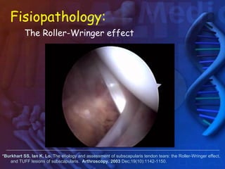 Coracoplastia, Artroscopia de hombro | PPT