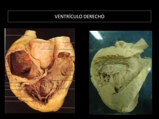 VENTRÍCULO DERECHO

 