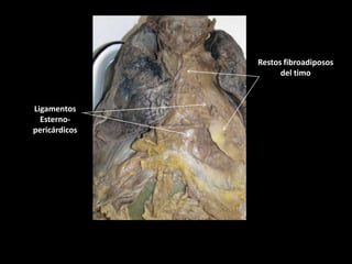 Restos fibroadiposos
del timo

Ligamentos
Esternopericárdicos

 