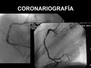 CORONARIOGRAFÍA

 