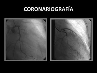 CORONARIOGRAFÍA

 