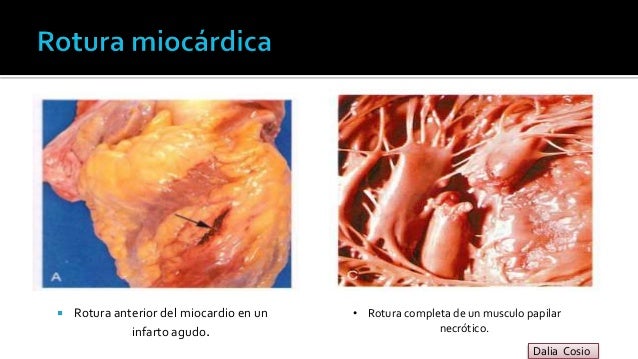 Se Recupera El Músculo Del Corazón Después De Un Infarto