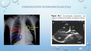COMUNICACIÓN INTERAURICULAR (CIA)
 