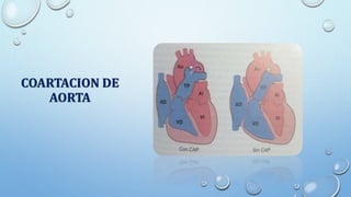 COARTACION DE
AORTA
 