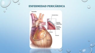 ENFERMEDAD PERICÁRDICA
 