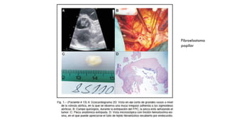 Fibroelastoma
papilar
 