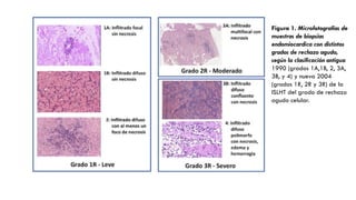 Figura 1. Microfotografías de
muestras de biopsias
endomiocardica con distintos
grados de rechazo agudo,
según la clasificación antigua
1990 (grados 1A,1B, 2, 3A,
3B, y 4) y nueva 2004
(grados 1R, 2R y 3R) de la
ISLHT del grado de rechazo
agudo celular.
 